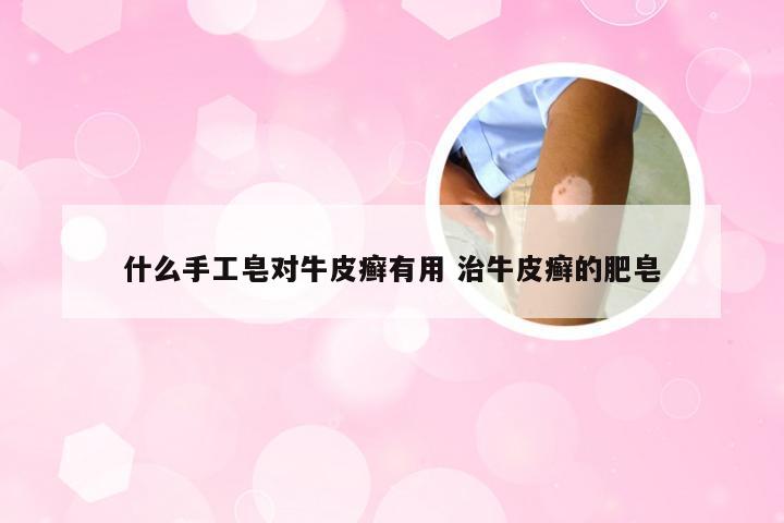 什么手工皂对牛皮癣有用 治牛皮癣的肥皂