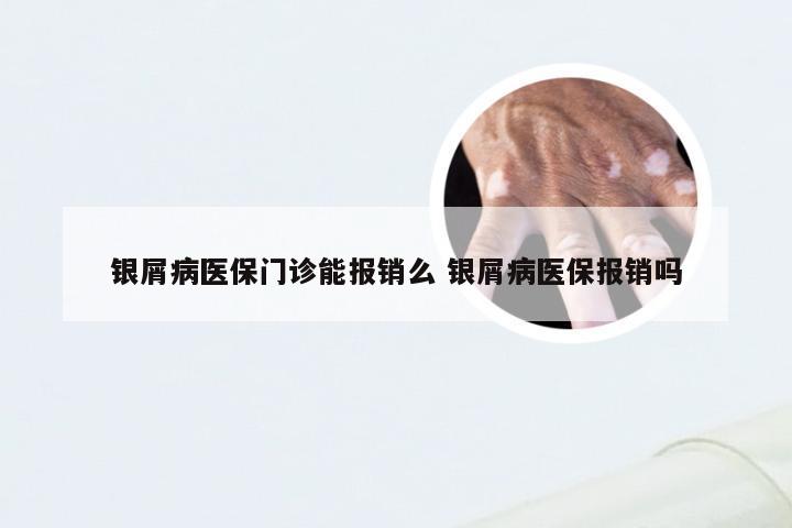 银屑病医保门诊能报销么 银屑病医保报销吗
