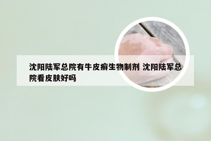 沈阳陆军总院有牛皮癣生物制剂 沈阳陆军总院看皮肤好吗