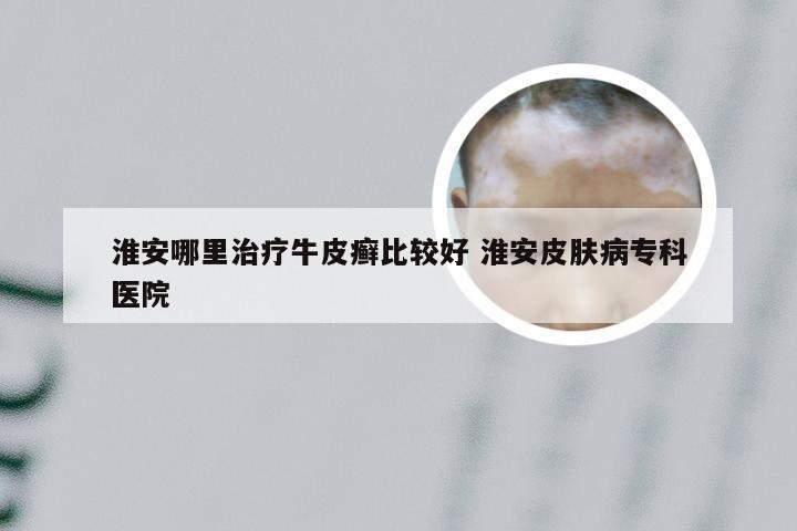 淮安哪里治疗牛皮癣比较好 淮安皮肤病专科医院