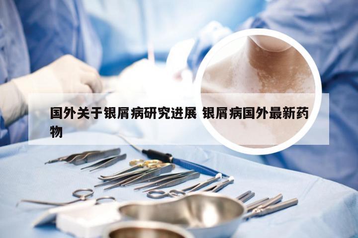 国外关于银屑病研究进展 银屑病国外最新药物