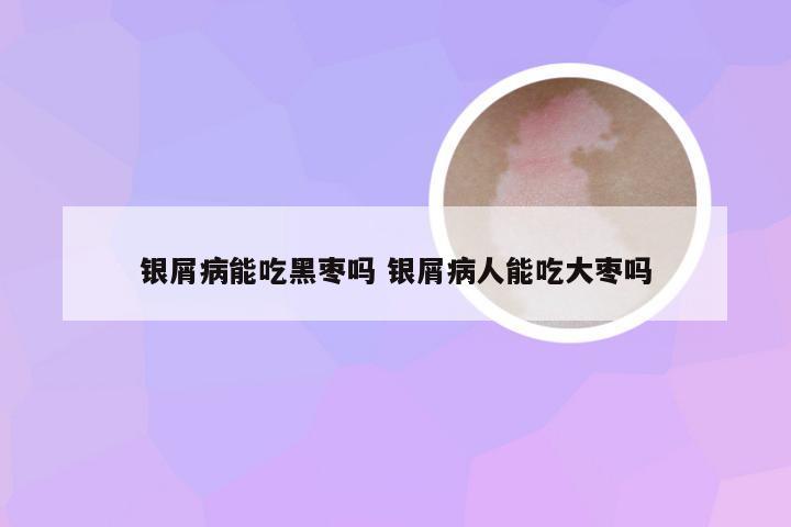 银屑病能吃黑枣吗 银屑病人能吃大枣吗