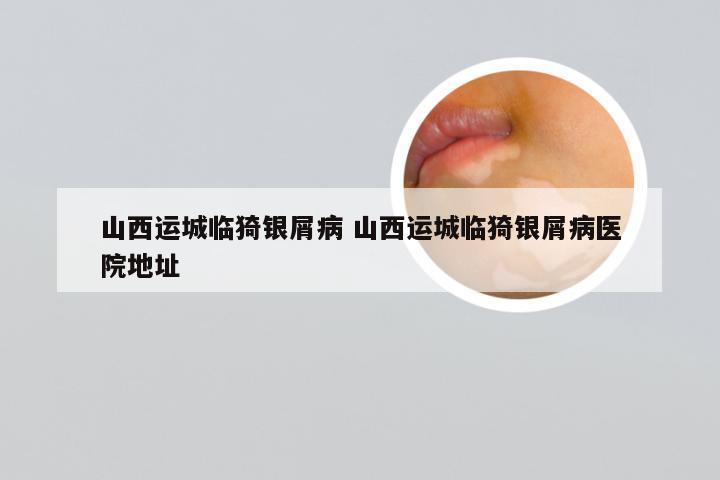 山西运城临猗银屑病 山西运城临猗银屑病医院地址