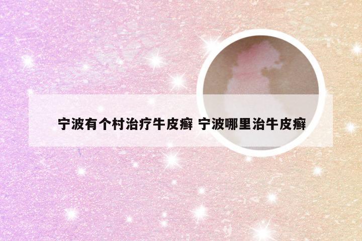 宁波有个村治疗牛皮癣 宁波哪里治牛皮癣
