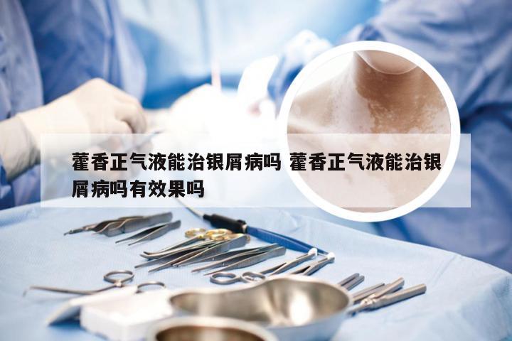 藿香正气液能治银屑病吗 藿香正气液能治银屑病吗有效果吗