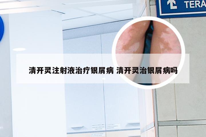 清开灵注射液治疗银屑病 清开灵治银屑病吗