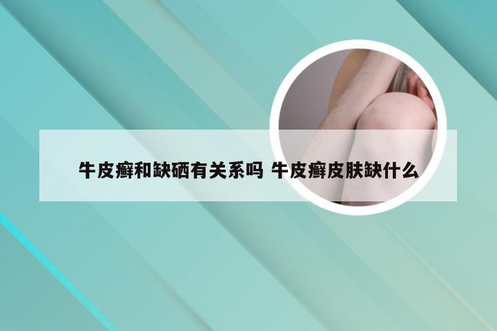 牛皮癣和缺硒有关系吗 牛皮癣皮肤缺什么