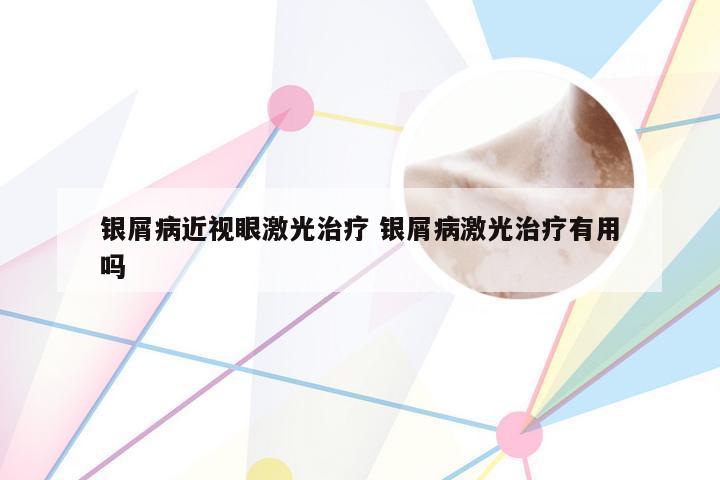 银屑病近视眼激光治疗 银屑病激光治疗有用吗