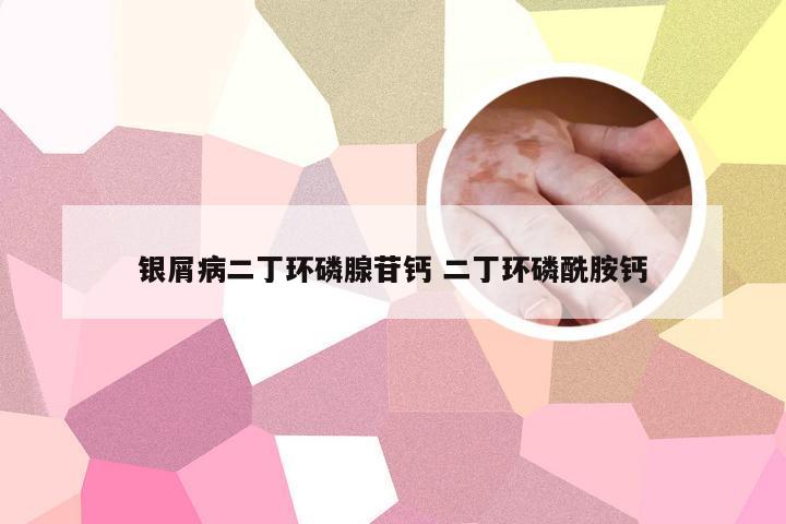 银屑病二丁环磷腺苷钙 二丁环磷酰胺钙