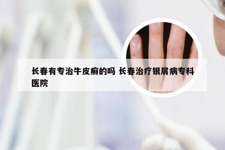 长春有专治牛皮癣的吗 长春治疗银屑病专科医院