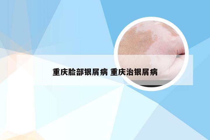重庆脸部银屑病 重庆治银屑病