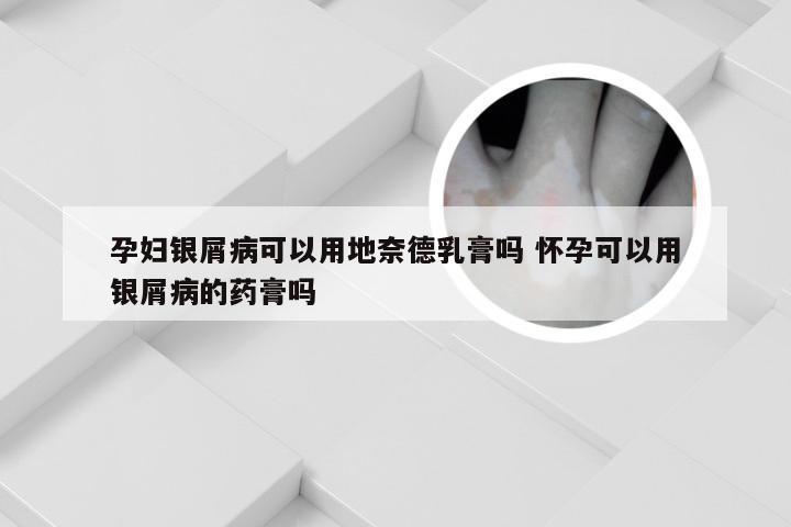 孕妇银屑病可以用地奈德乳膏吗 怀孕可以用银屑病的药膏吗