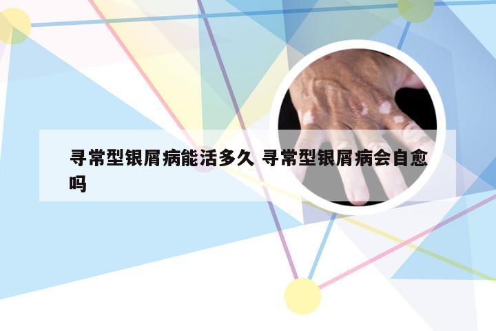 寻常型银屑病能活多久 寻常型银屑病会自愈吗