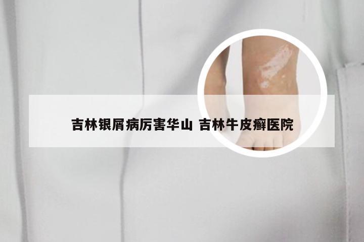 吉林银屑病厉害华山 吉林牛皮癣医院