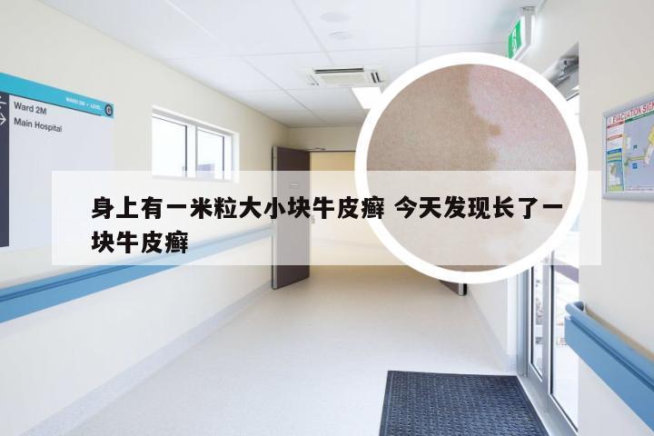 身上有一米粒大小块牛皮癣 今天发现长了一块牛皮癣