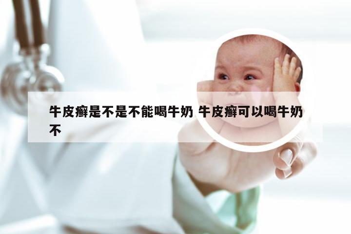 牛皮癣是不是不能喝牛奶 牛皮癣可以喝牛奶不