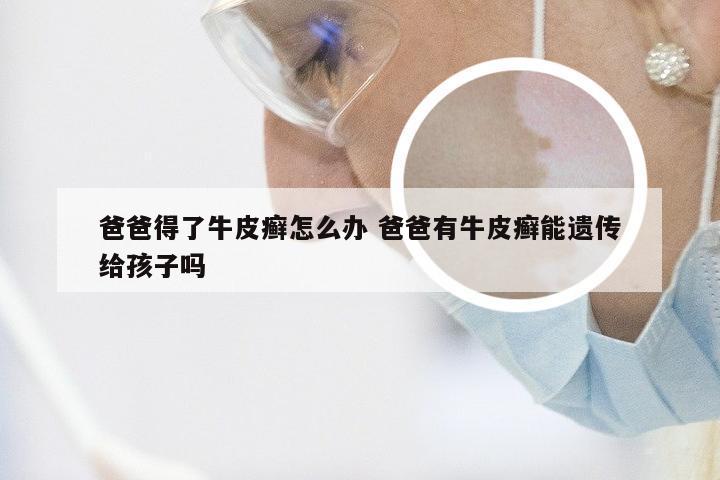 爸爸得了牛皮癣怎么办 爸爸有牛皮癣能遗传给孩子吗