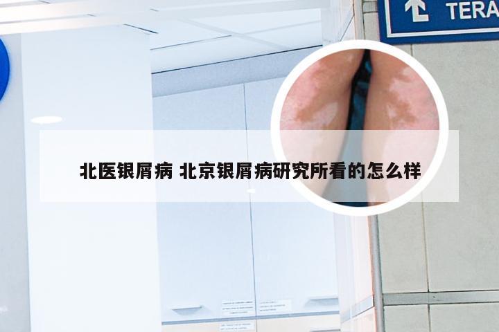 北医银屑病 北京银屑病研究所看的怎么样