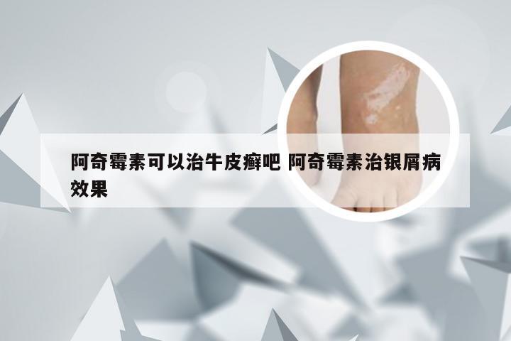阿奇霉素可以治牛皮癣吧 阿奇霉素治银屑病效果