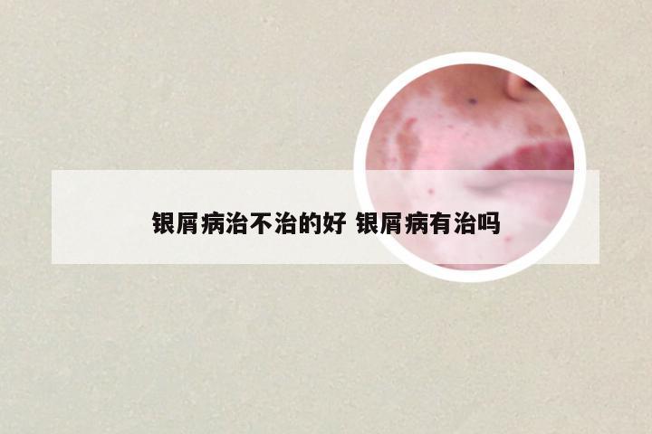银屑病治不治的好 银屑病有治吗