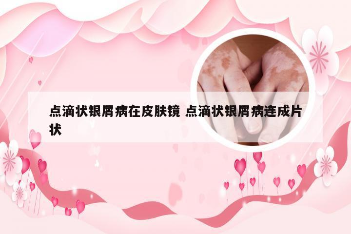 点滴状银屑病在皮肤镜 点滴状银屑病连成片状