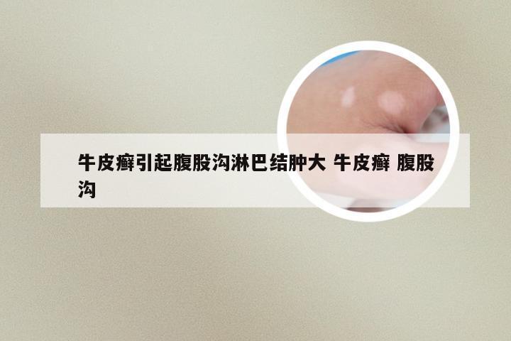 牛皮癣引起腹股沟淋巴结肿大 牛皮癣 腹股沟