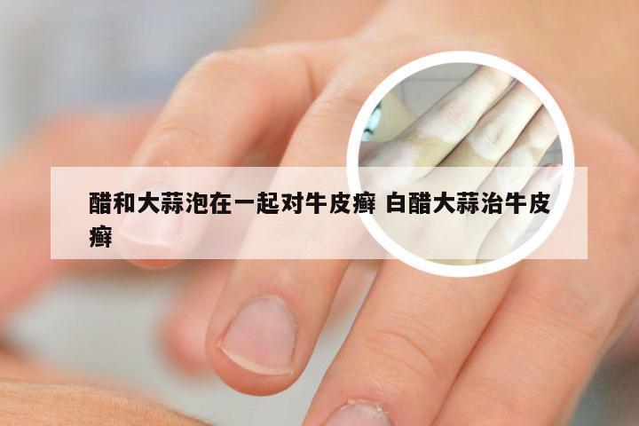 醋和大蒜泡在一起对牛皮癣 白醋大蒜治牛皮癣