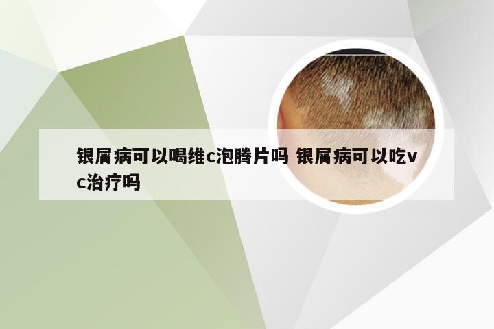 银屑病可以喝维c泡腾片吗 银屑病可以吃vc治疗吗