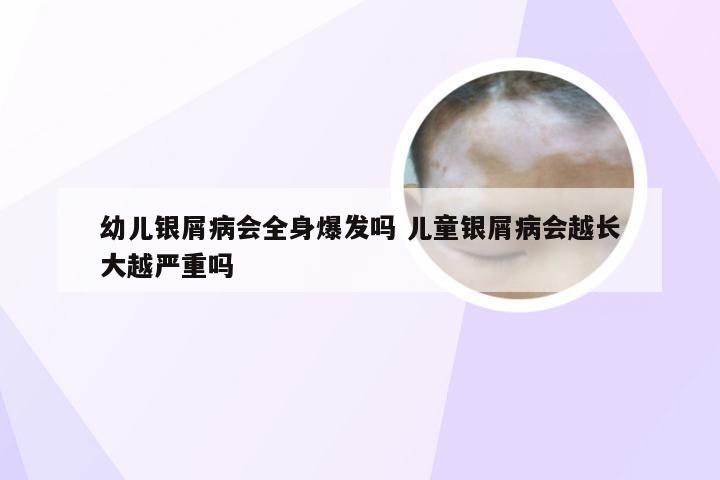 幼儿银屑病会全身爆发吗 儿童银屑病会越长大越严重吗