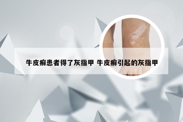 牛皮癣患者得了灰指甲 牛皮癣引起的灰指甲