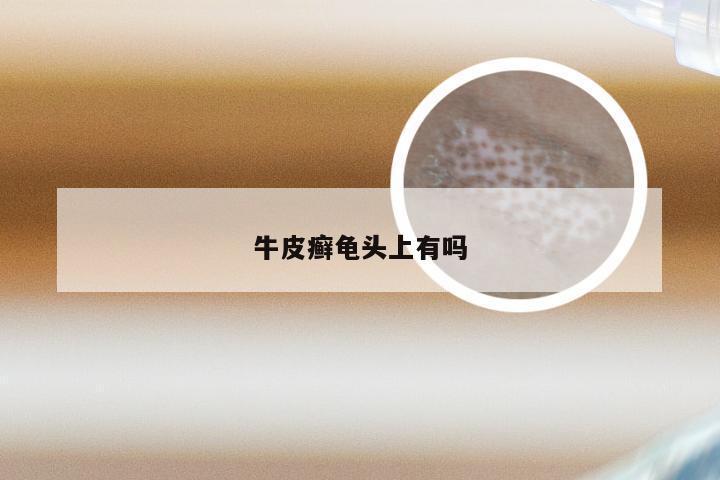 牛皮癣龟头上有吗