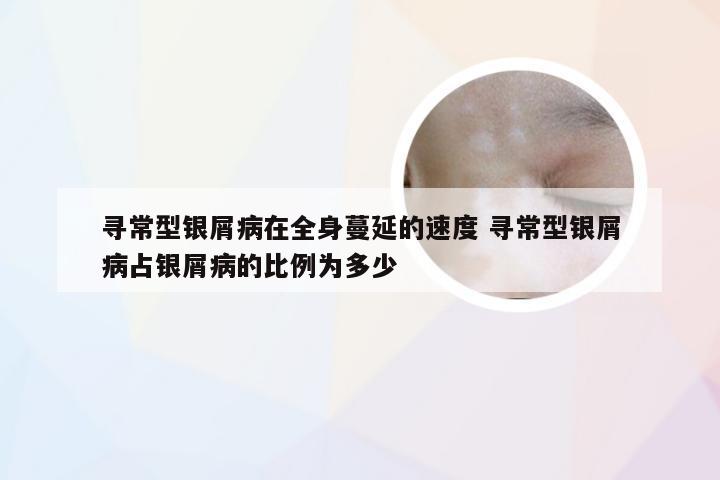 寻常型银屑病在全身蔓延的速度 寻常型银屑病占银屑病的比例为多少