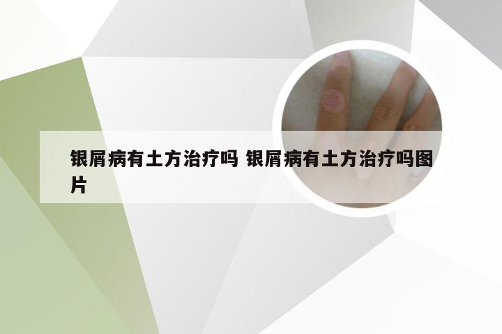 银屑病有土方治疗吗 银屑病有土方治疗吗图片