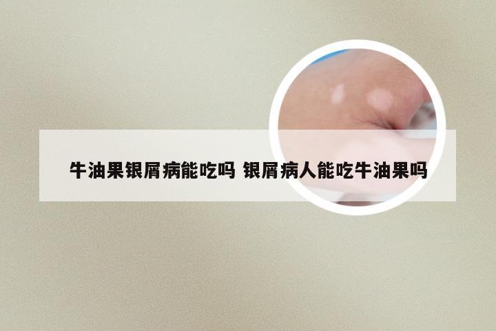 牛油果银屑病能吃吗 银屑病人能吃牛油果吗