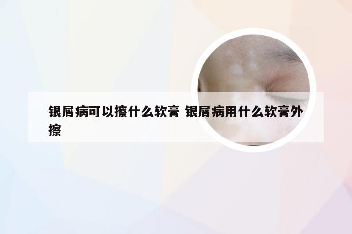 银屑病可以擦什么软膏 银屑病用什么软膏外擦