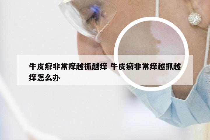 牛皮癣非常痒越抓越痒 牛皮癣非常痒越抓越痒怎么办