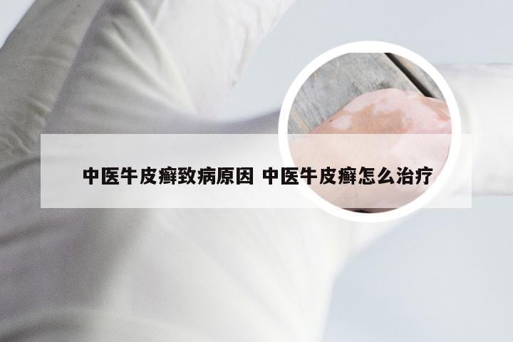中医牛皮癣致病原因 中医牛皮癣怎么治疗