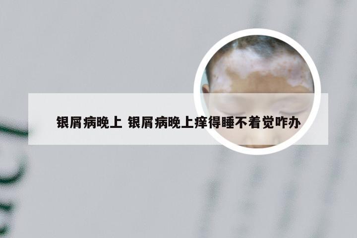 银屑病晚上 银屑病晚上痒得睡不着觉咋办