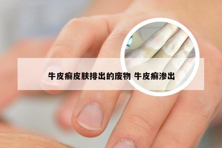 牛皮癣皮肤排出的废物 牛皮癣渗出