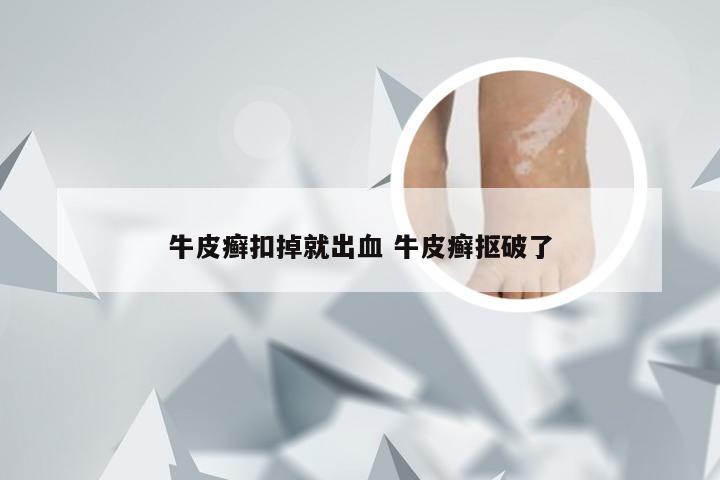 牛皮癣扣掉就出血 牛皮癣抠破了