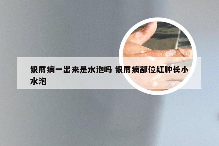 银屑病一出来是水泡吗 银屑病部位红肿长小水泡