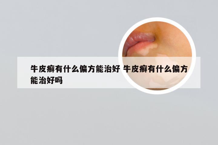牛皮癣有什么偏方能治好 牛皮癣有什么偏方能治好吗