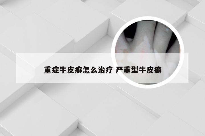 重症牛皮癣怎么治疗 严重型牛皮癣