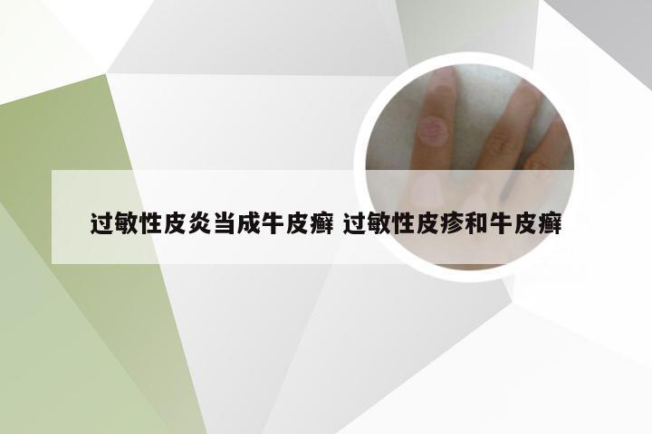 过敏性皮炎当成牛皮癣 过敏性皮疹和牛皮癣