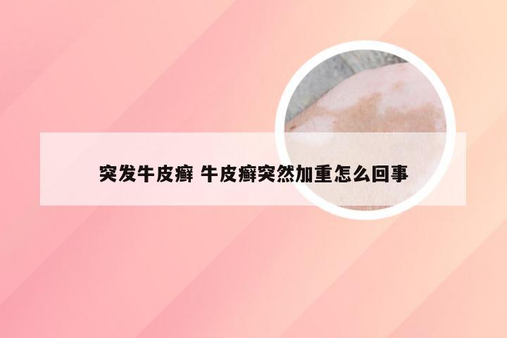 突发牛皮癣 牛皮癣突然加重怎么回事