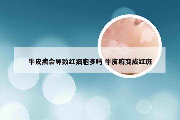 牛皮癣会导致红细胞多吗 牛皮癣变成红斑