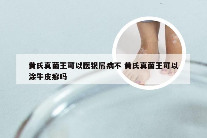 黄氏真菌王可以医银屑病不 黄氏真菌王可以涂牛皮癣吗