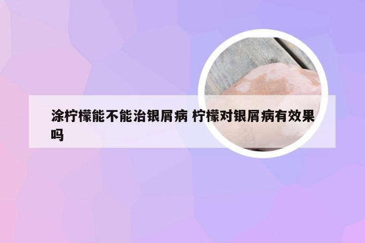 涂柠檬能不能治银屑病 柠檬对银屑病有效果吗