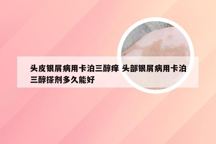 头皮银屑病用卡泊三醇痒 头部银屑病用卡泊三醇搽剂多久能好