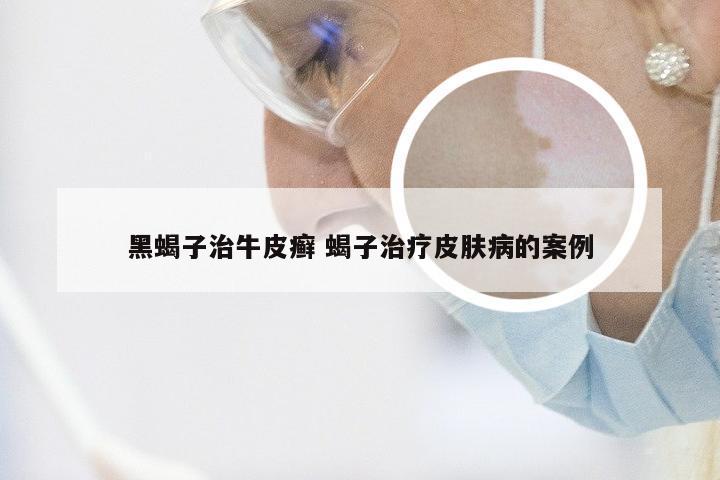 黑蝎子治牛皮癣 蝎子治疗皮肤病的案例